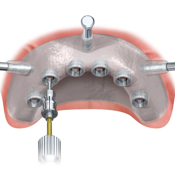 Von Nobel Biocare angefertigte chirurgische Schiene zur kontrollierten, geplanten Implantierung