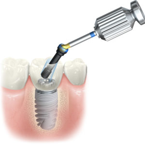 Corona zirconio con acceso dinamico Corona zirconio con acceso dinamico