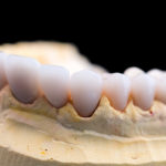 Coronas y carillas de e-max estratificadas