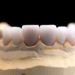 Coronas y carillas de e-max estratificadas