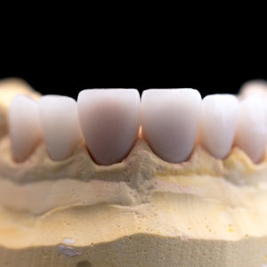 Coronas y carillas de e-max estratificadas Coronas y carillas de e-max estratificadas