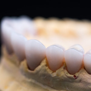 Coronas y carillas de e-max estratificadas Coronas y carillas de e-max estratificadas