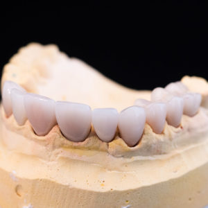 Coronas y carillas de e-max estratificadas Coronas y carillas de e-max estratificadas