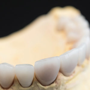 Coronas y carillas de e-max estratificadas Coronas y carillas de e-max estratificadas