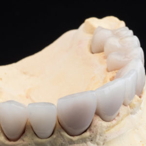 Coronas y carillas de e-max estratificadas Coronas y carillas de e-max estratificadas