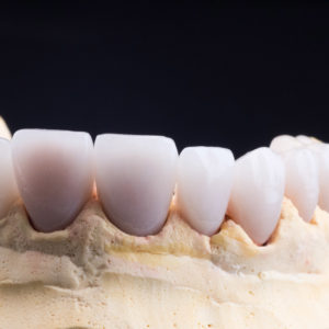 Coronas y carillas de e-max estratificadas Coronas y carillas de e-max estratificadas