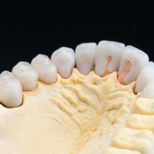 Coronas y carillas de e-max estratificadas Coronas y carillas de e-max estratificadas