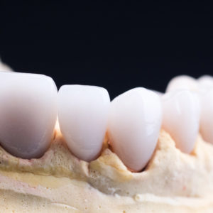 Coronas y carillas de e-max estratificadas Coronas y carillas de e-max estratificadas