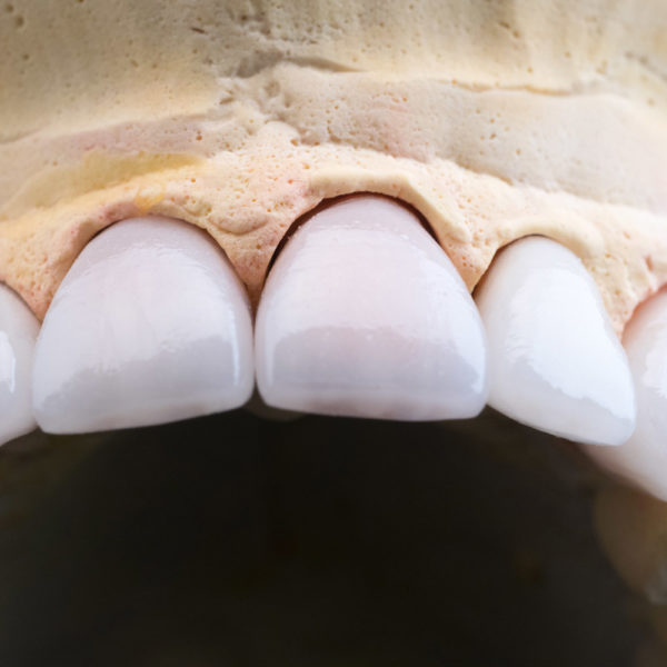 Coronas y carillas de e-max estratificadas Coronas y carillas de e-max estratificadas