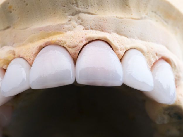 Coronas y carillas de e-max estratificadas