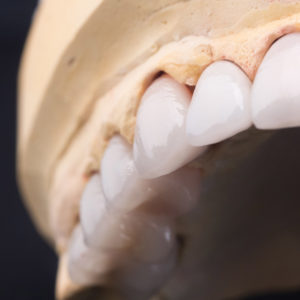 Coronas y carillas de e-max estratificadas Coronas y carillas de e-max estratificadas