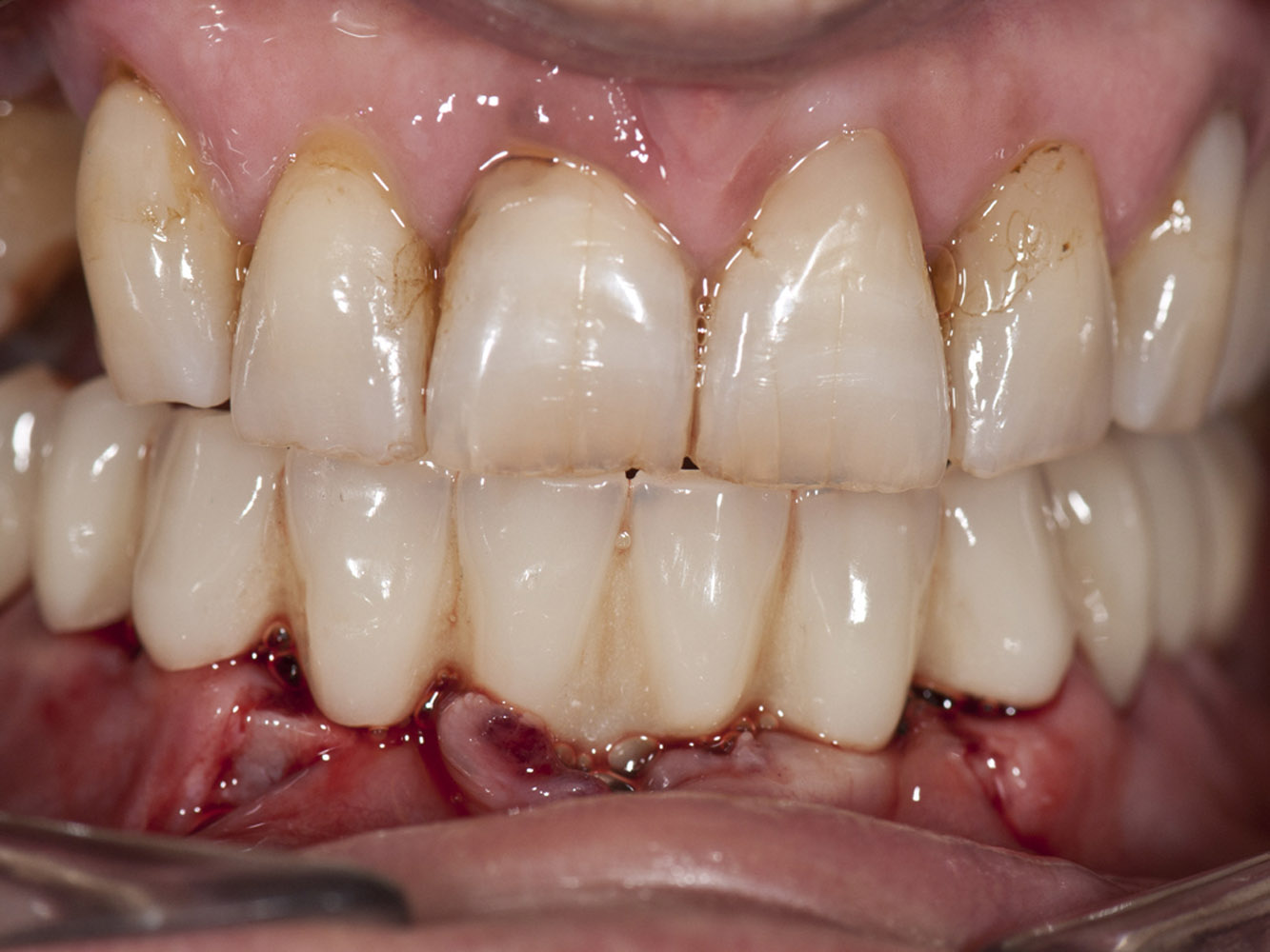 Carga inmediata inferior