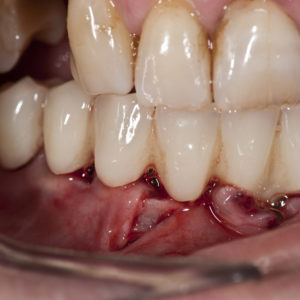 Carga inmediata inferior Carga inmediata inferior