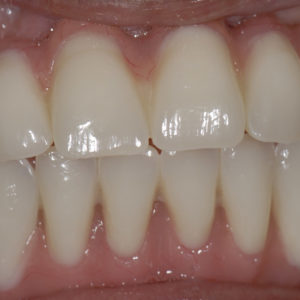 Hibrida Superior e Inferior Hibrida Superior e Inferior