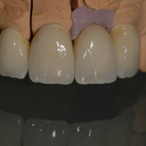 Coronas dento y implantosoportado Coronas dento y implantosoportado