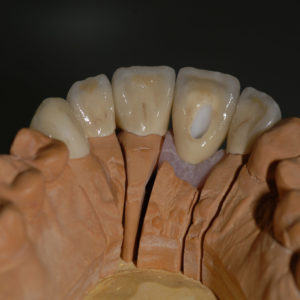 Coronas dento y implantosoportado Coronas dento y implantosoportado