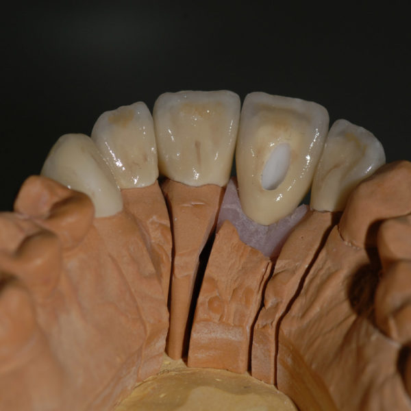 Coronas dento y implantosoportado Coronas dento y implantosoportado