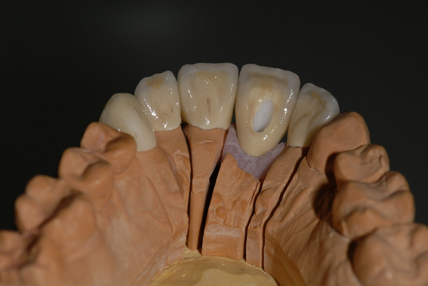 Coronas dento y implantosoportado