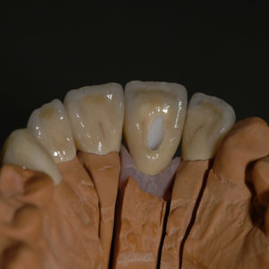 Coronas dento y implantosoportado Coronas dento y implantosoportado