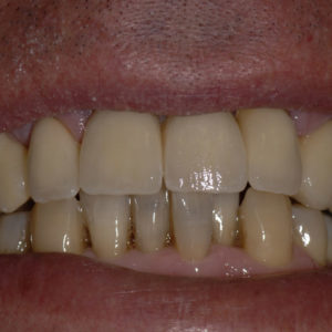 Coronas dento y implantosoportadas Coronas dento y implantosoportadas