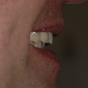 Coronas dento y implantosoportadas Coronas dento y implantosoportadas