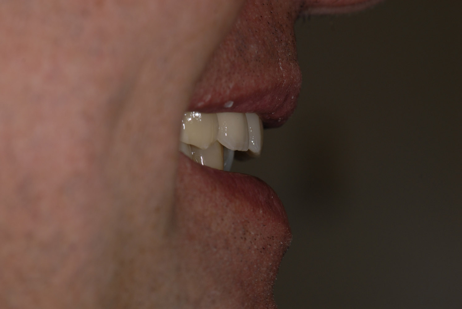 Coronas dento y implantosoportadas