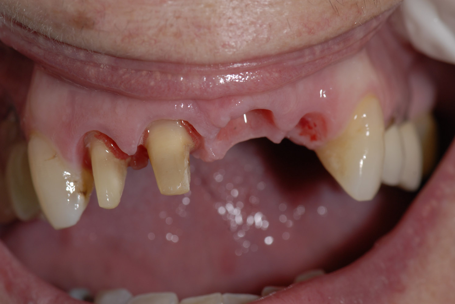 Coronas dento y implantosoportadas