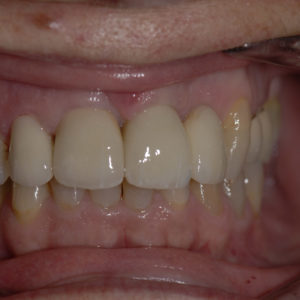 Coronas dento e implantosoportado Coronas dento e implantosoportado