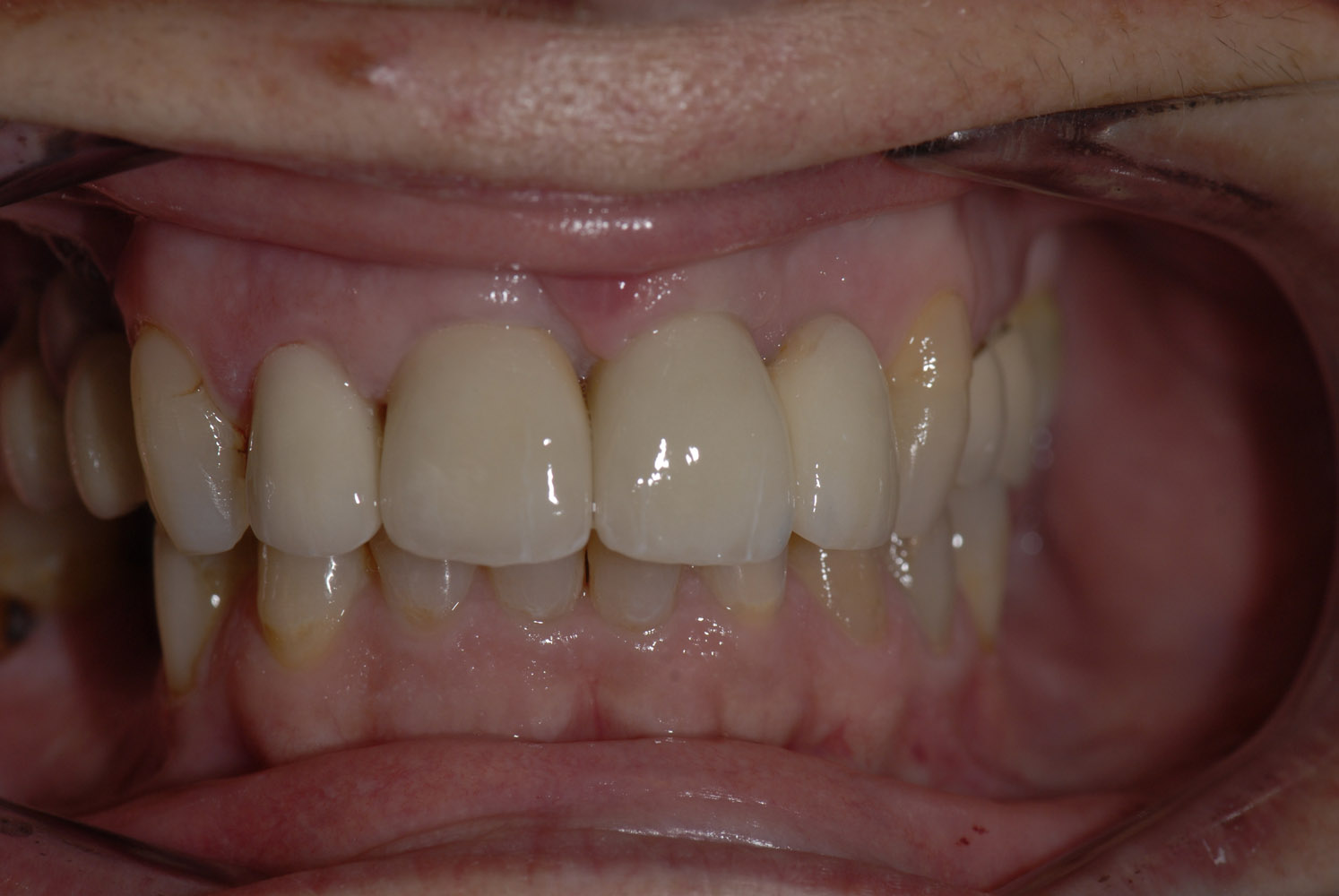 Coronas dento e implantosoportado