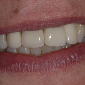 Coronas dento e implantosoportado Coronas dento e implantosoportado