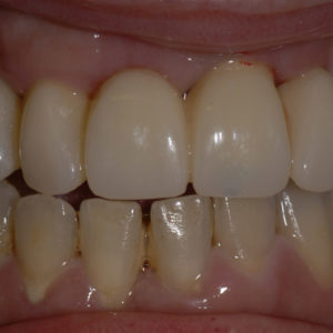 Hibrida superior Hibrida Superior