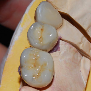 Coronas individuales Coronas individuales