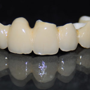 Puente zirconio dentosoportado Puente zirconio dentosoportado