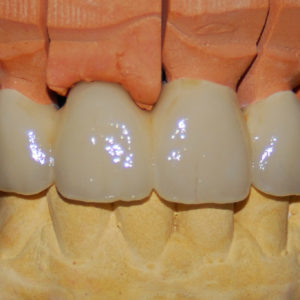 Puente zirconio dentosoportado Puente zirconio dentosoportado