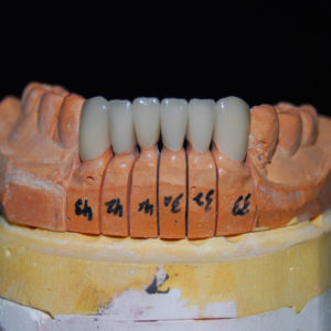 Coronas E-max Coronas E-max