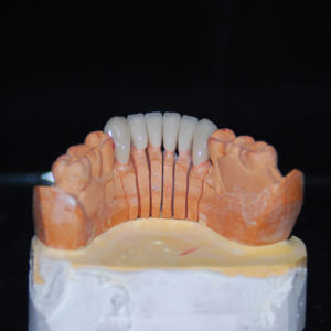 Coronas E-max Coronas E-max