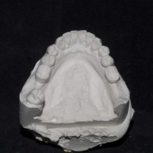 Carga inmediata Molde de escayola para información