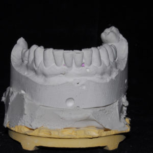 Inferior antes de extraccion para carga inmediata Molde de escayola para información