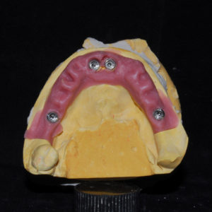 Carga inmediata inferior Carga inmediata inferior