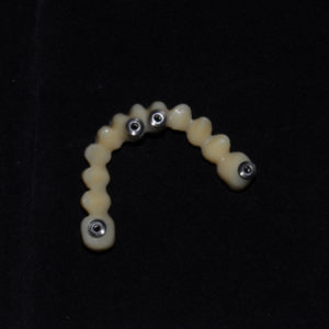 Protesis provisional para carga inmediata Protesis provisional para carga inmediata