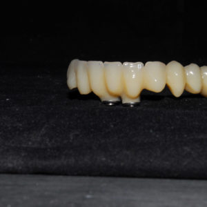 Protesis provisional para carga inmediata Protesis provisional para carga inmediata