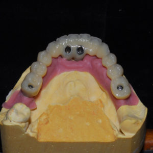 Protesis provisional para carga inmediata Protesis provisional para carga inmediata