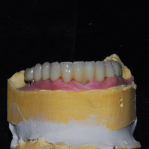 Protesis provisional para carga inmediata despues de colocacion de 4 implantes Protesis provisional para carga inmediata