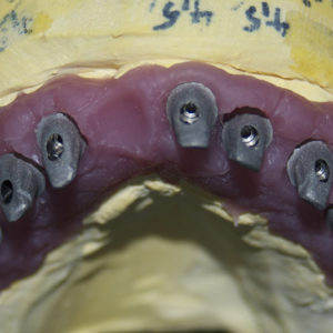 Protesis telescopica superior Protesis telescopica superior