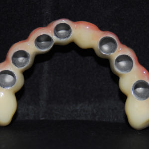 Protesis telescopica superior Protesis telescopica superior