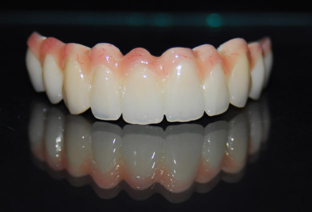 Protesis telescopica superior