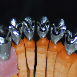 Coronas metalceramica con microfresado Coronas metalceramica con microfresado