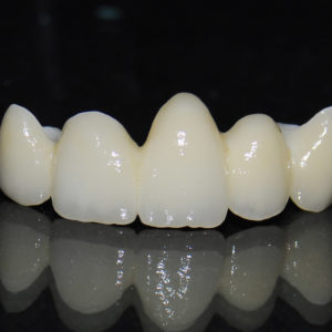 Puente zirconio Puente zirconio