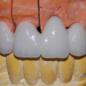 Puente zirconio Puente zirconio