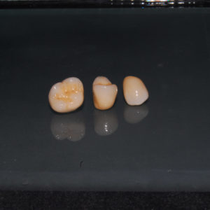 Coronas individuales Coronas individuales